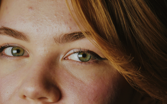 adult acne and stress showing on woman skin