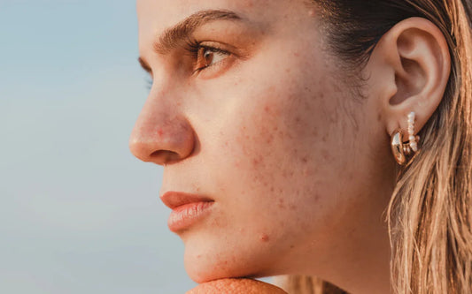 blonde girl with hormonal skin acne staring in the distance